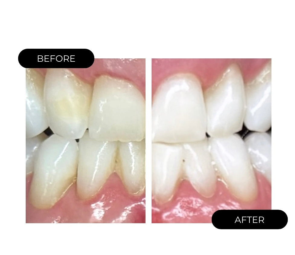 Why Teeth Whitening Results Are Different for Everyone